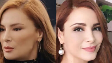 چه بلایی بر سر چهره زیبای بازیگر مشهور ترک آمده؟